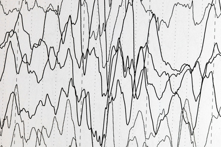 Abnormal brain wave in human EEG of the patients problems in the electrical activity of the brain.Abnormal EEG.の写真素材