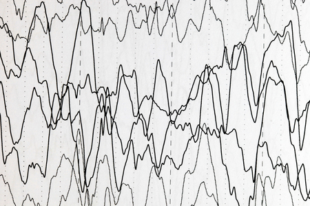 Abnormal brain wave in human EEG of the patients problems in the electrical activity of the brain.Abnormal EEG.の写真素材