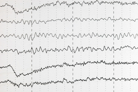 Abnormal brain wave in human EEG of the patients problems in the electrical activity of the brain.Abnormal EEG.の写真素材