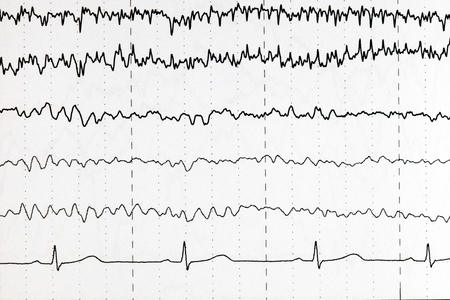Abnormal brain wave in human EEG of the patients problems in the electrical activity of the brain.Abnormal EEG.の写真素材