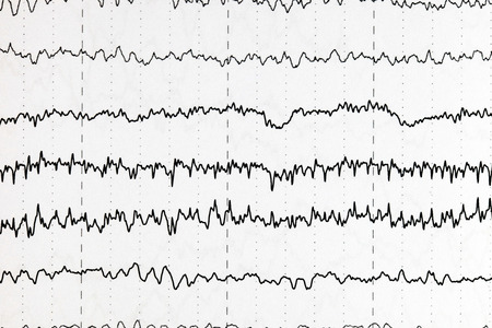 Abnormal brain wave in human EEG of the patients problems in the electrical activity of the brain.Abnormal EEG.の写真素材