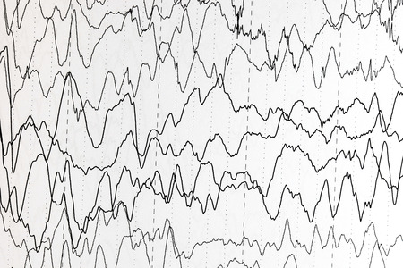 Abnormal brain wave in human EEG of the patients problems in the electrical activity of the brain.Abnormal EEG.の写真素材