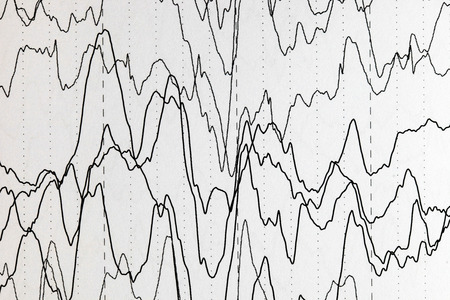 Abnormal brain wave in human EEG of the patients problems in the electrical activity of the brain.Abnormal EEG.の写真素材