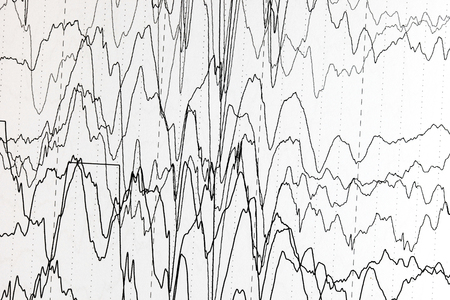 Abnormal brain wave in human EEG of the patients problems in the electrical activity of the brain.Abnormal EEG.の写真素材