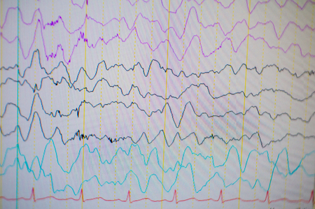 A computer monitor showing electrical activity of abnormal brain, electroencephalogram,EEGの写真素材