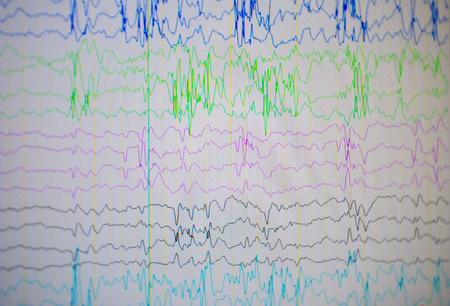 A computer monitor showing electrical activity of abnormal brain, electroencephalogram,EEGの写真素材