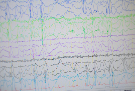 A computer monitor showing electrical activity of abnormal brain, electroencephalogram,EEGの写真素材