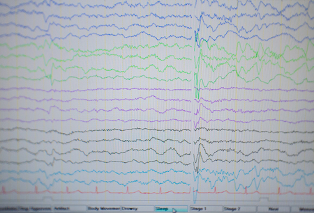 A computer monitor showing electrical activity of abnormal brain, electroencephalogram,EEGの写真素材