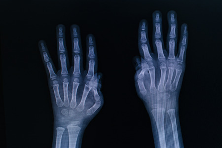 Film x-ray of both hand.の写真素材