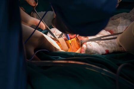 Surgeon during  liver surgery  for patient treatment  in operating room.の写真素材