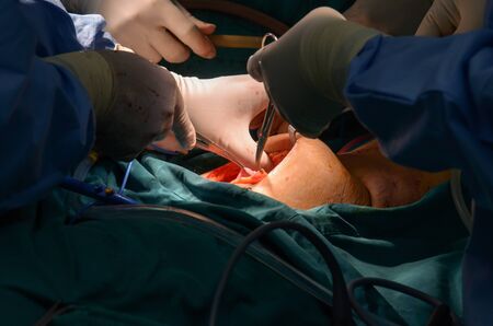 Surgeon during  liver surgery  for patient treatment  in operating room.の写真素材