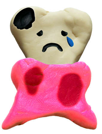 3d clay art crying face decay tooth and Alveolar pyorrheaの写真素材
