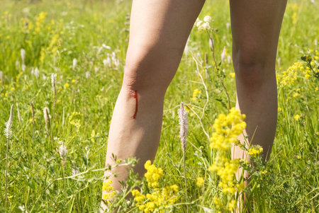 woman with bloody scrape on legの写真素材
