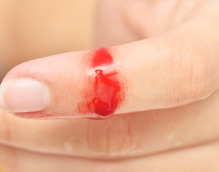 Flesh wound with blood on fingerの写真素材