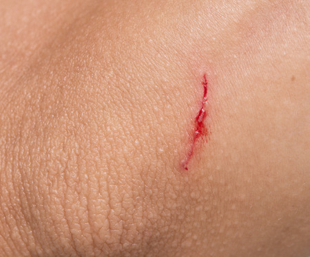 wound on human skin