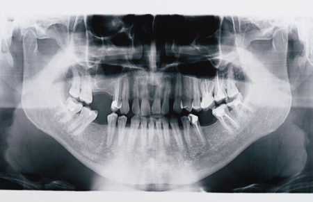panoramic x-ray of human teeth before implantingの写真素材