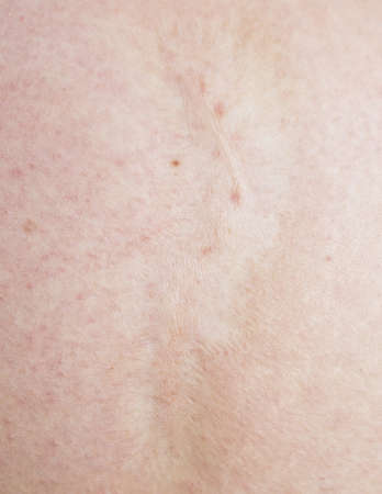close up of scar on human skinの写真素材
