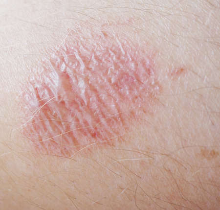 burning skinの写真素材