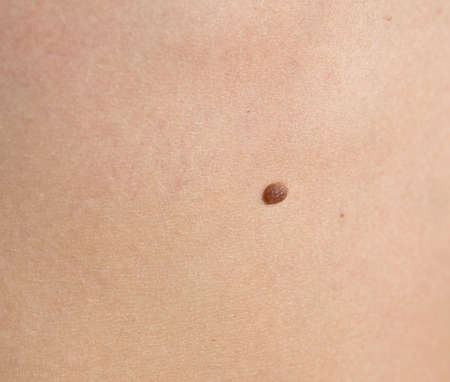 close up of mole on human skinの写真素材