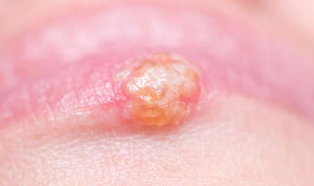 Close up shot of herpes on lipの写真素材