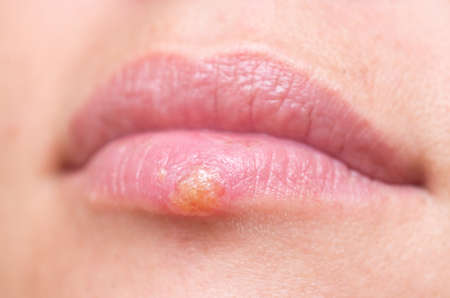 Close up shot of herpes on lipsの写真素材