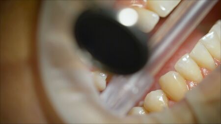 Examination of the teeth in the dental clinic.. Dentist examining a patient's teeth in the dentist.の写真素材