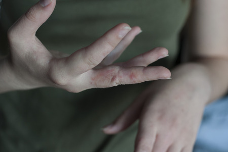 Pain in hands. Sore at woman hand. Scabies in macroの写真素材
