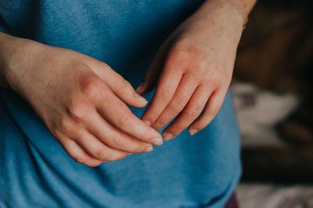 Eczema symptom. Dermatology allergy problem on hands closeup