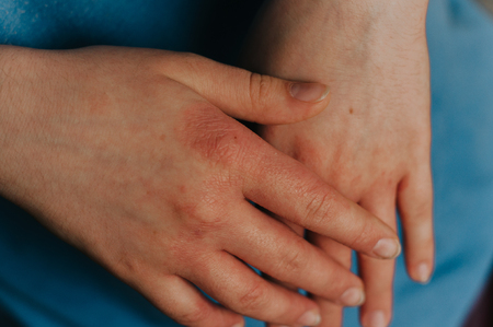 Eczema infection on hands closeup. Red scratch armsの写真素材