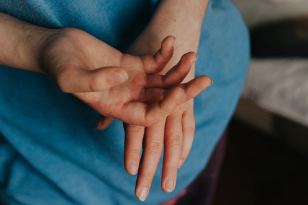 Woman sick hands. Scabies in handsの写真素材