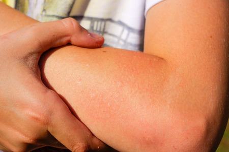 a Upper arm skin showing fresh wasp sting. Close up.の写真素材