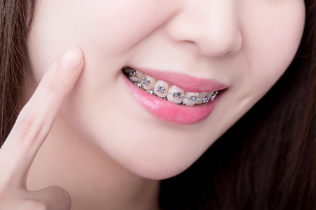 close up of woman wear brace and touch her faceの写真素材