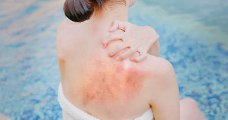 back view of asian young woman scratches back while Sunburn on her skin in front of swimming poolの写真素材
