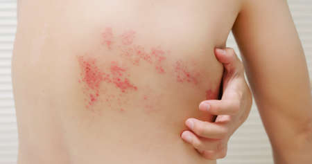 man with shingles disease on skin and he feel very painfulの写真素材