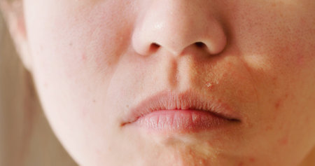close up of asian woman has acne problem on face and dry lipsの写真素材