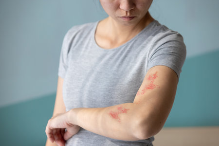 Woman with shingles on the skin she feels very painfulの写真素材