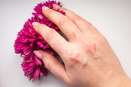 Womens hand with red papillomas on the skin