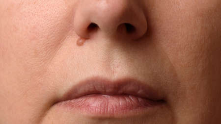 Closeup of mole or nevus under nose on woman face. Concept of timely diagnosisの写真素材