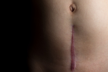 A recovering scar from a c-section operation dramatically faded to black.の写真素材