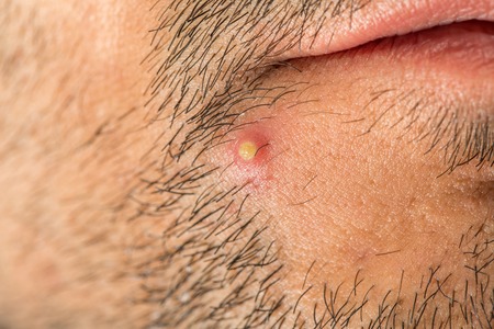 Caucasian man with stub and big pimpleの写真素材