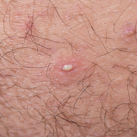 ingrown hair closeupの写真素材
