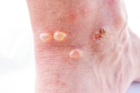 Closeup of ankle with blistersの写真素材