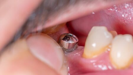 Super closeup macro view of dental implantの写真素材