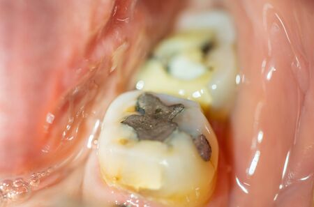 Filling in back tooth closeup macro viewの写真素材