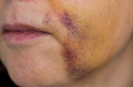 Unrecognizable woman with bruises in the faceの写真素材