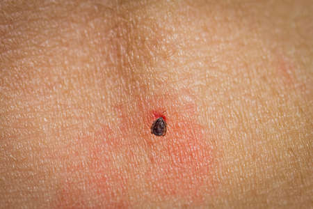 Dangerous tick over the skin closeup viewの写真素材