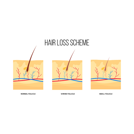 Human hair loss scheme flat style, vector illustration isolated on white background. Graphic diagram of hair follicles condition with hair growth problem, anatomical medical infographics