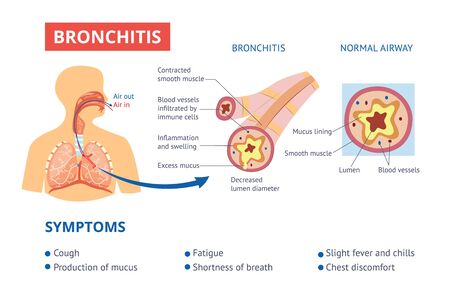 Labeled medical diagram with healthy airway and illness of bronchitis diagnosis vector banner illustration. Pulmonary problems and symptoms of bronchitis disease.のイラスト素材
