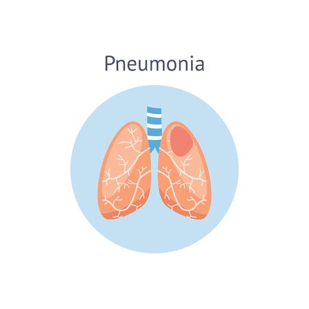 Pneumonia disease diagram a difference of healthy and damaged lungs vector illustration isolated on white background. Respiratory system symbol for medical and science use.のイラスト素材