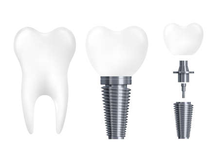 Dental implant parts - realistic white tooth with titanium metal screw attached to ceramic crown. Dentistry prosthesis divided into elements, isolated vector illustration.のイラスト素材
